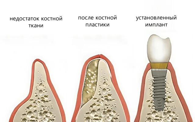 Имплантация при недостатке кости: современные методы