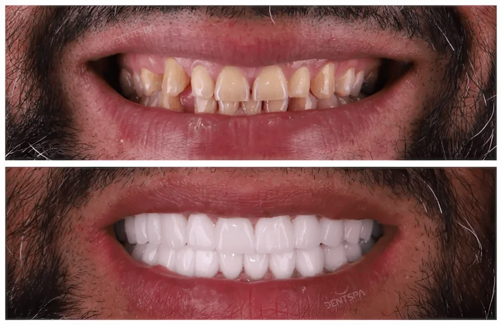 Пациент выбрал слишком белые виниры, которые выглядели неестественно
