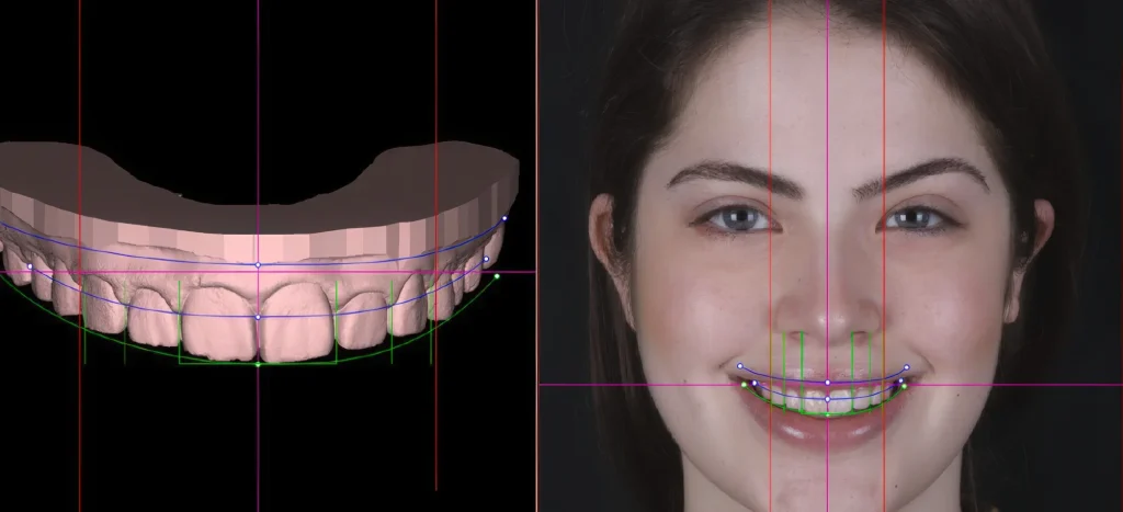 Цифровой дизайн улыбки (Digital Smile Design)