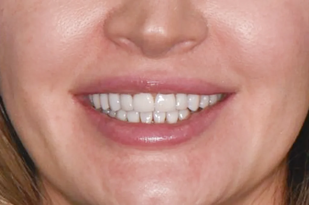 Виниры из стеклокерамики E.max - после