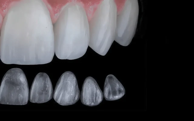 Современные материалы для виниров и коронок