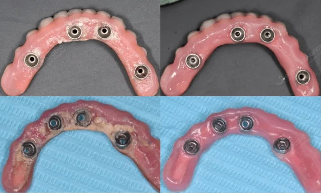До и после гигиены протезов на имплантах